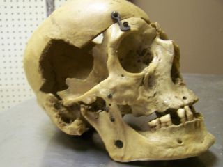 Pre 1920 Real Human Medical Skull Weird Freaky Science Bones Skeleton